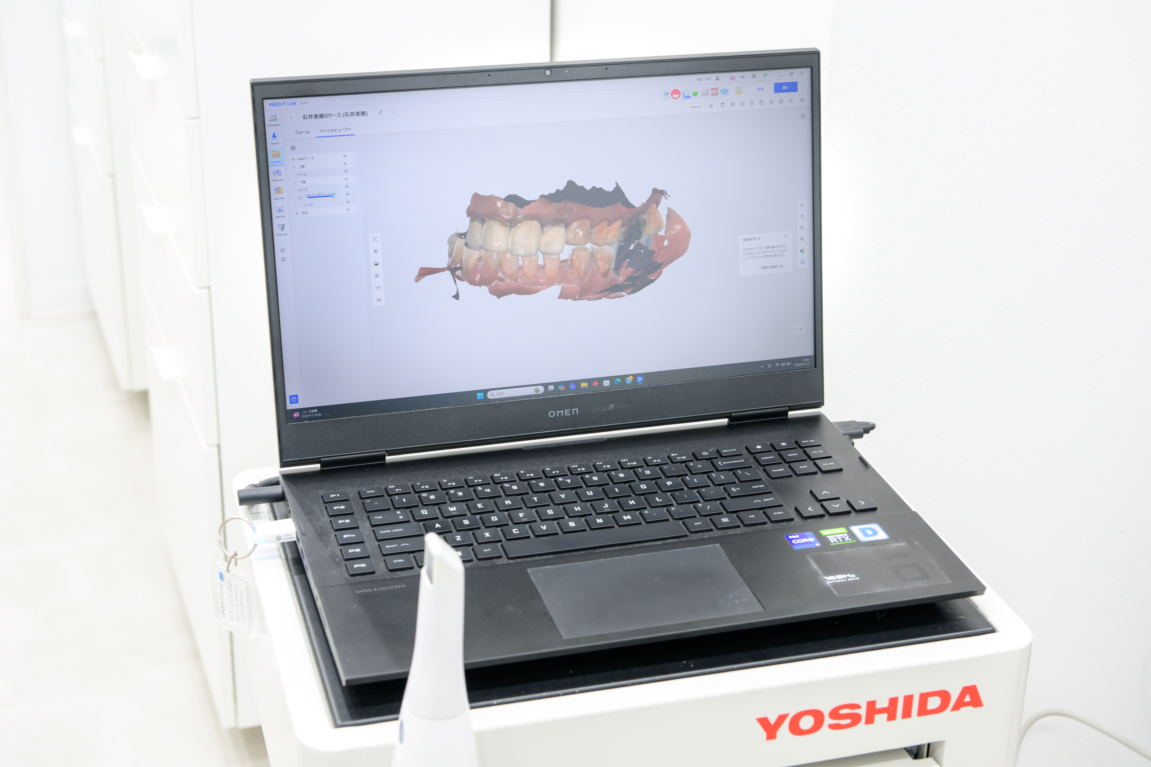 口腔内スキャナー