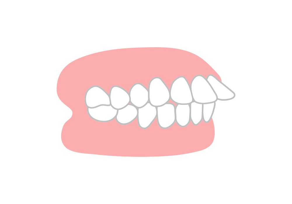 上顎前突（じょうがくぜんとつ）