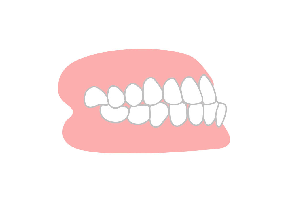 下顎前突（かがくぜんとつ）