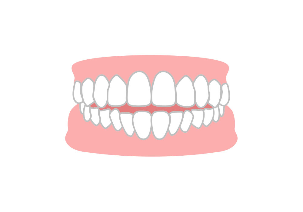 開咬（かいこう）