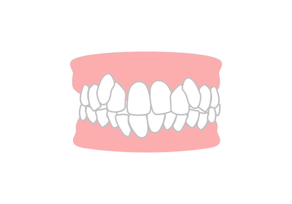 叢生（そうせい）