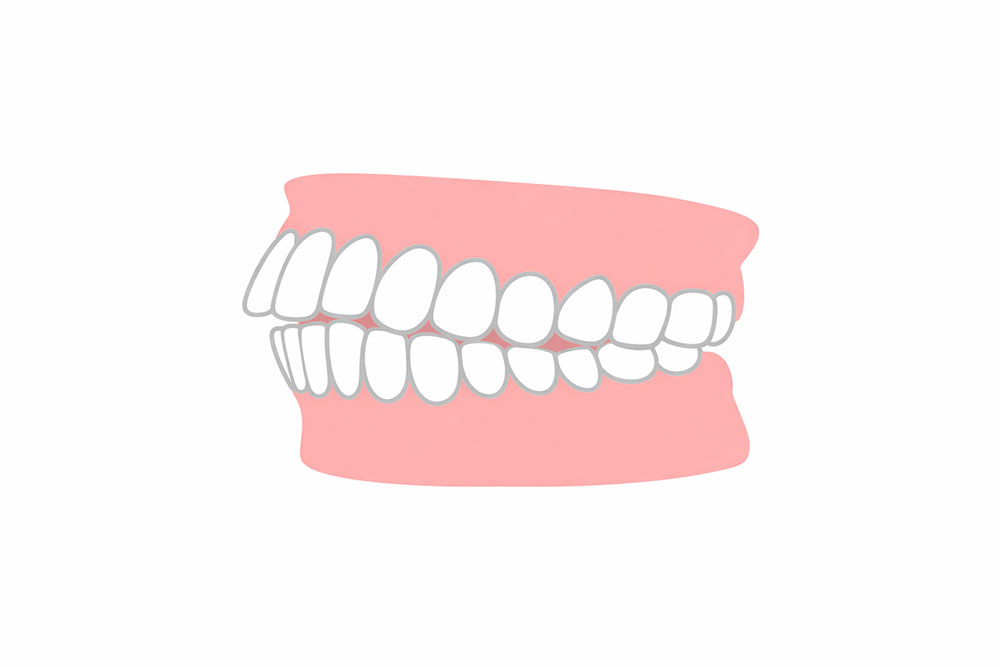 上下顎前突（じょうかがくぜんとつ）