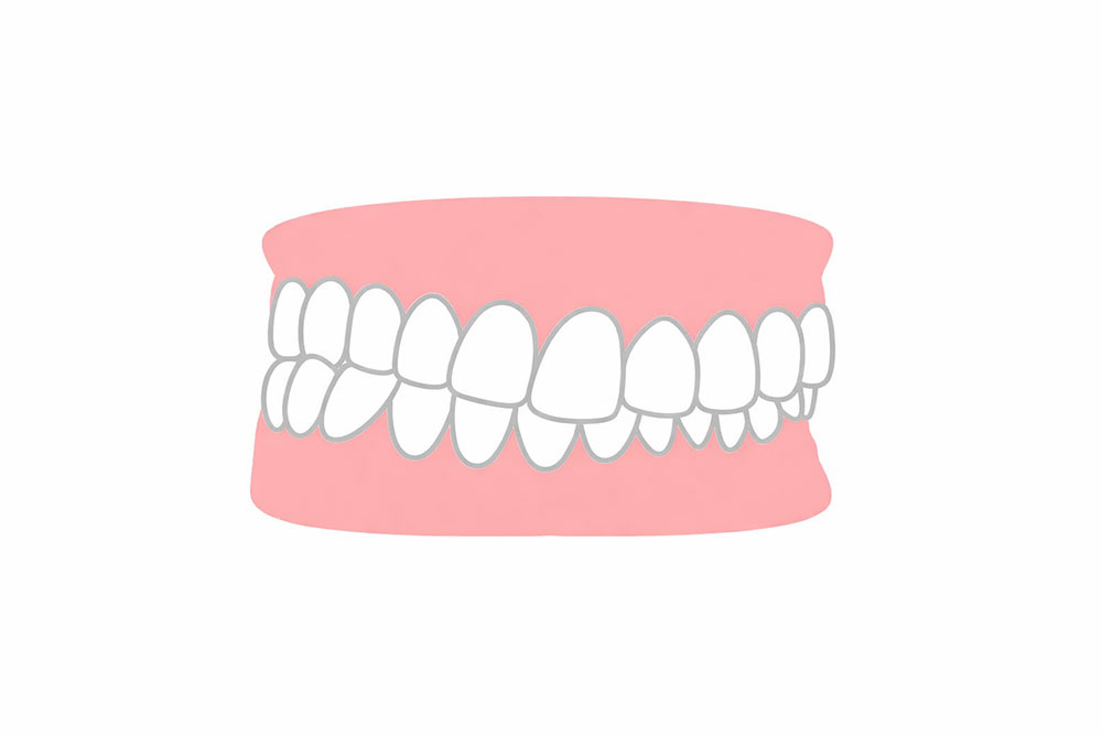 交叉咬合（こうさこうごう）