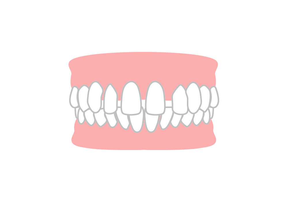 空隙歯列（くうげきしれつ）