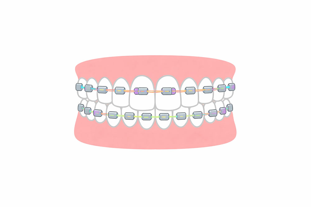 マルチブラケット