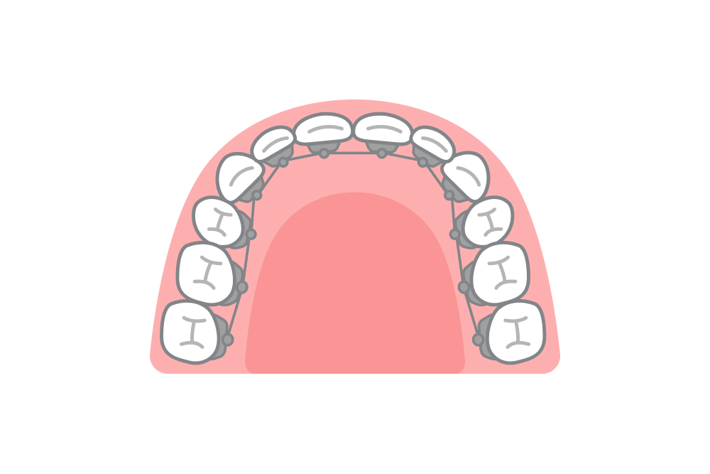 リンガルブラケット