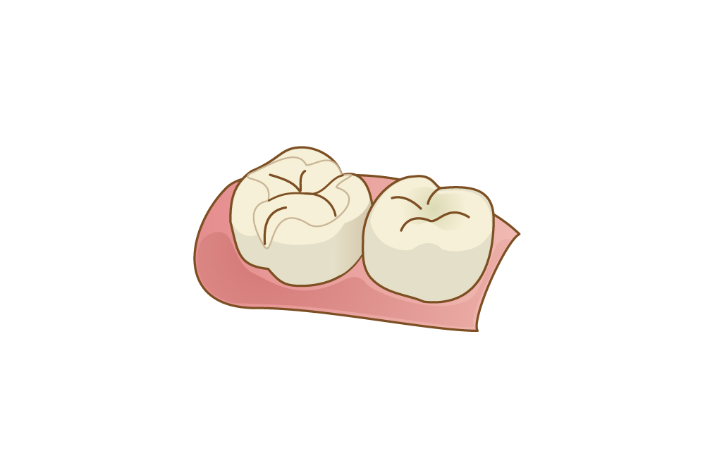 コンポジットレジン