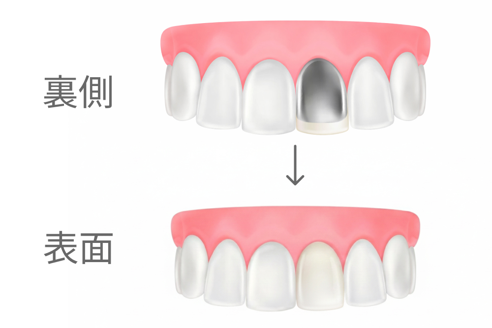 硬質レジン前装冠