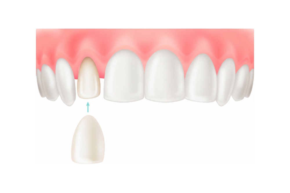 ラミネートべニア